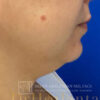 Neck Liposuction case #3870