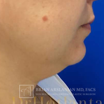 Neck Liposuction case #3870