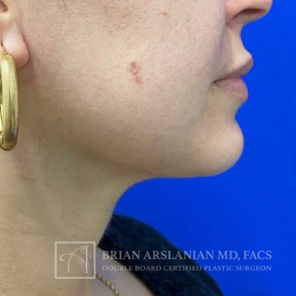 Neck Liposuction case #3870