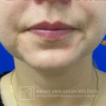 Neck Liposuction case #3870