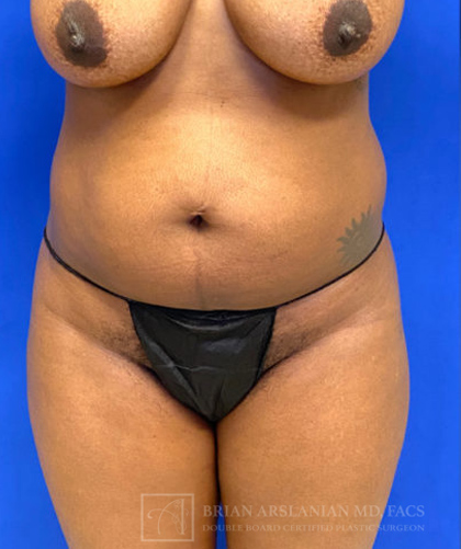 Liposuction case #3716