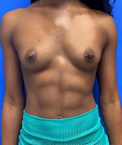 Breast Augmentation case #2703