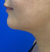 Neck Liposuction case #3882