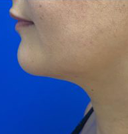 Neck Liposuction case #3882