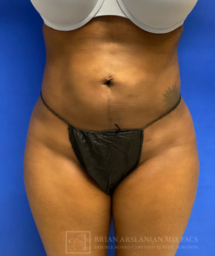 Liposuction case #3716