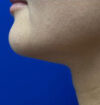 Neck Liposuction case #3882