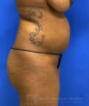 Liposuction case #3716