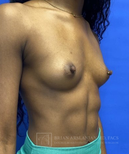 Breast Augmentation case #2703