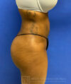 Liposuction case #3716