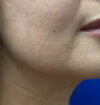 Neck Liposuction case #3882