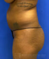 Liposuction case #3716