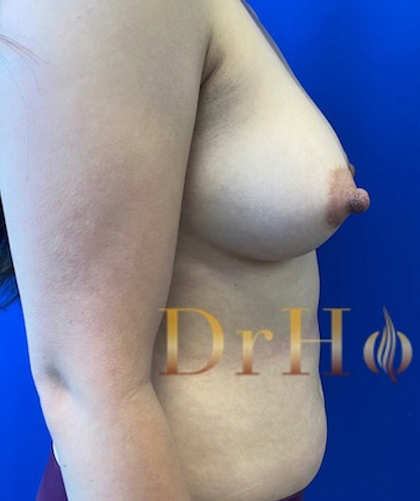 Breast Augmentation case #2714