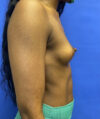 Breast Augmentation case #2703