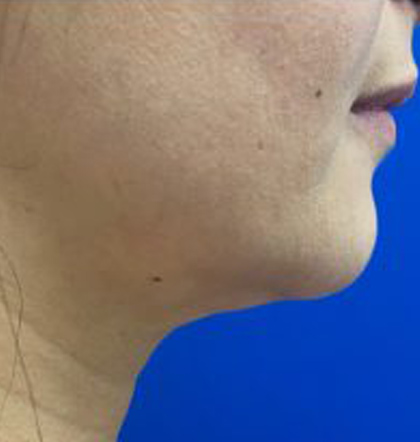 Neck Liposuction case #3882