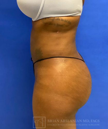 Liposuction case #3716