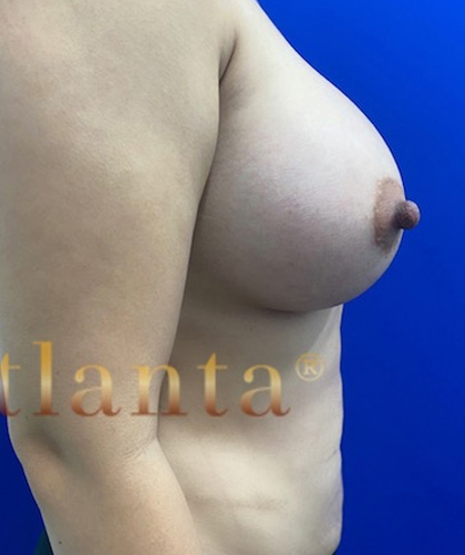 Breast Augmentation case #2714