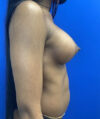 Breast Augmentation case #2703