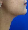 Neck Liposuction case #3882