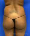 Liposuction case #3716