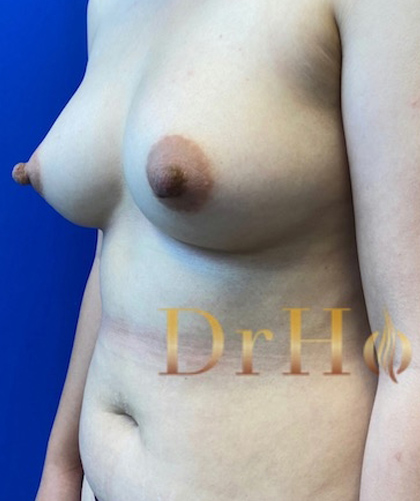 Breast Augmentation case #2714