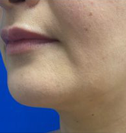 Neck Liposuction case #3882