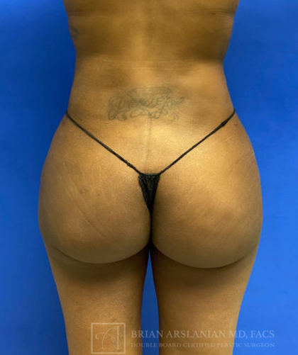 Liposuction case #3716