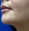 Neck Liposuction case #3882