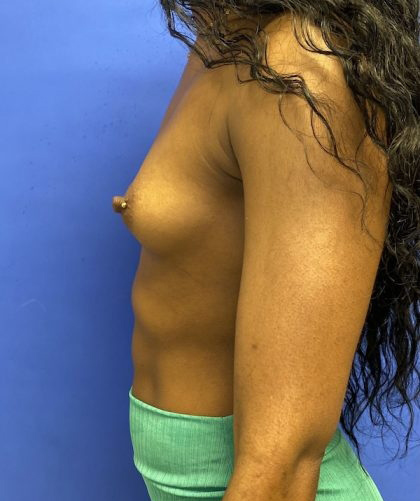 Breast Augmentation case #2703