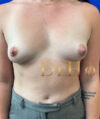 Breast Augmentation case #2725
