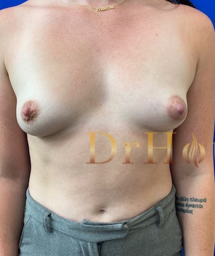 Breast Augmentation case #2725