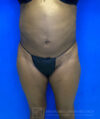 Liposuction case #3725