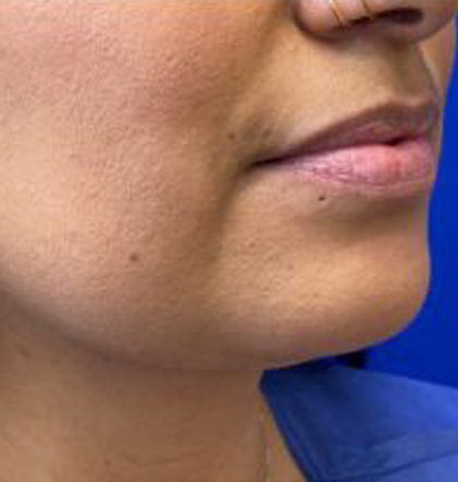 Neck Liposuction case #3894