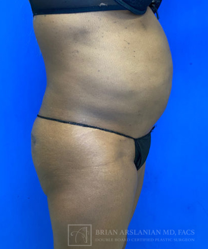 Liposuction case #3725