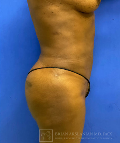 Liposuction case #3725