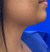 Neck Liposuction case #3894