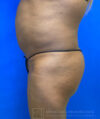 Liposuction case #3725