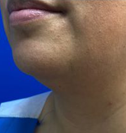 Neck Liposuction case #3894