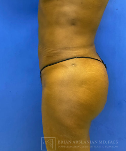 Liposuction case #3725