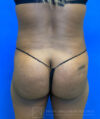 Liposuction case #3725