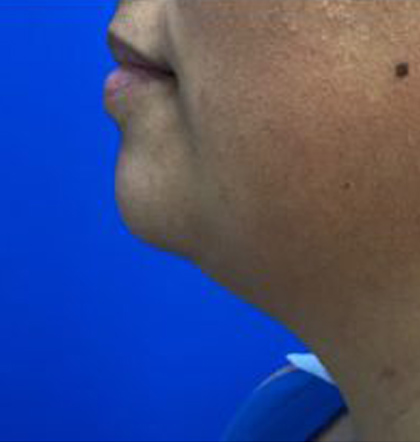 Neck Liposuction case #3894