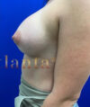 Breast Augmentation case #2725