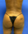 Liposuction case #3725