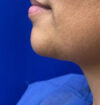 Neck Liposuction case #3894