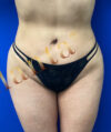 Liposuction case #3734