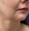 Neck Liposuction case #3914