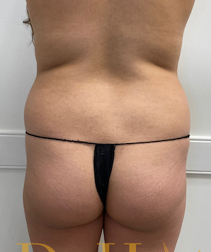 Liposuction case #3734