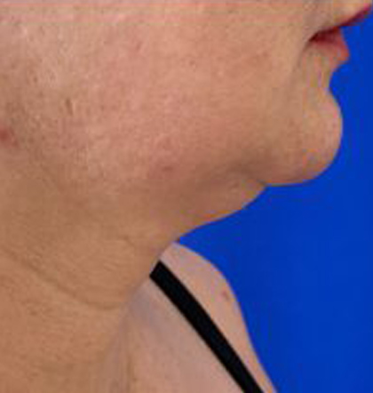 Neck Liposuction case #3914