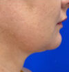 Neck Liposuction case #3914