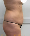 Liposuction case #3734