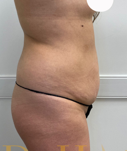 Liposuction case #3734
